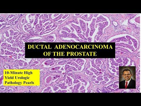 Ductal adenocarcinoma of the prostate