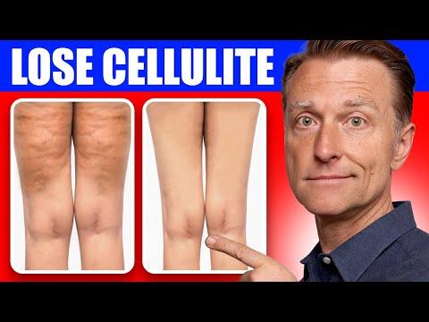 How to Get Rid of Cellulite