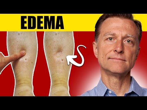 8 Surprising Causes of Edema: Uncover the Truth!