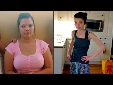 The Deadly Consequences of Extreme Weight Loss Methods: A Cautionary Tale