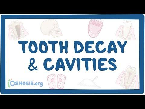 Preventing Tooth Decay: A Comprehensive Guide