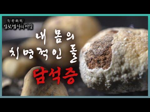 치료법 소개! 담석증으로 인한 합병증 방지 방법