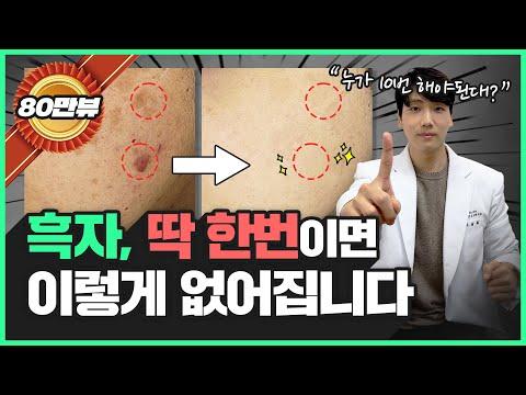 흑자 치료: 1번만 받아도 100% 치료 가능한데, 왜 레이저 10번이나 받으세요?