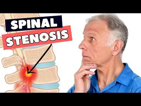 Cómo aliviar la estenosis espinal lumbar: 8 consejos efectivos