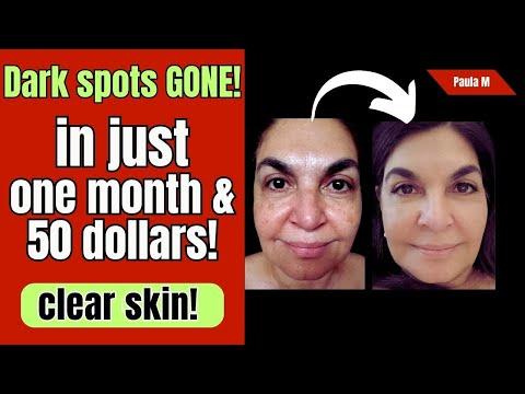 Say Goodbye to Dark Spots: Transform Your Skin in One Month!