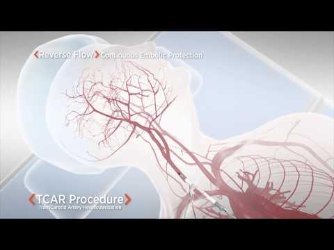 Preventing and Treating Carotid Artery Disease: Key Insights and FAQs