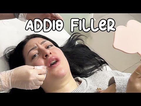 Removing Filler After 7 Years: A Transformation Journey 💉