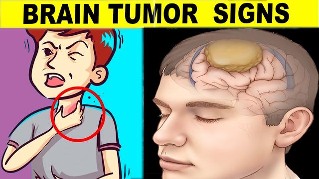 Understanding Brain Tumors: Symptoms, Risks, and Treatment