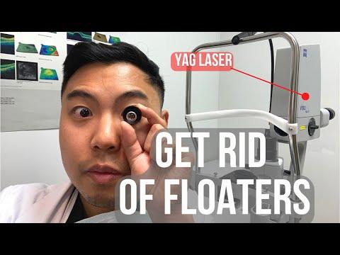 Understanding Eye Floaters: Treatments, Risks, and Recommendations